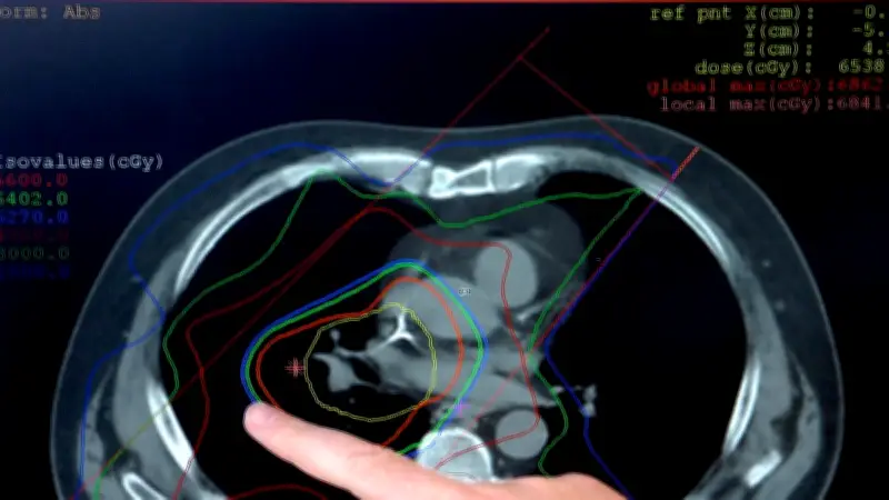 Cancer du poumon : percée montpelliéraine sur la résistance aux chimiothérapies