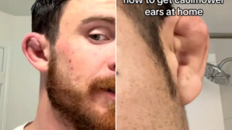 TikTok : la dangereuse mode des "oreilles en chou-fleur" volontaires