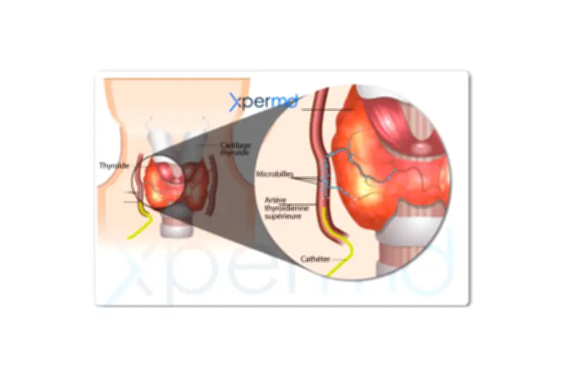 Un centre innovant révolutionne le traitement des pathologies thyroïdiennes sans chirurgie