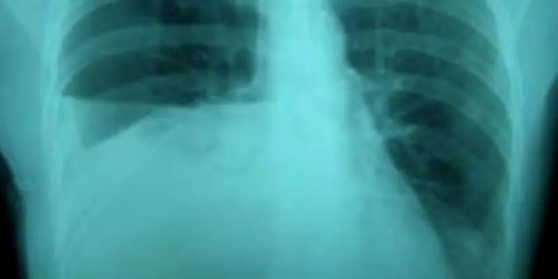 Urinothorax : quand l'urine migre dans la plèvre, une complication rarissime