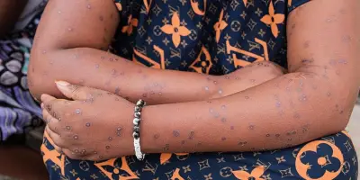 Mpox à Mayotte : neuf cas confirmés, l'ARS juge la situation peu inquiétante