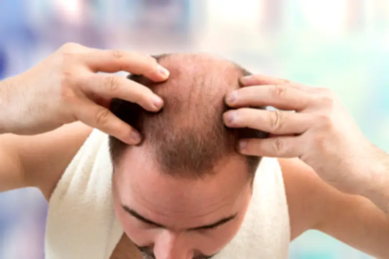 Chute de cheveux : les traitements scientifiquement prouvés pour préserver sa chevelure