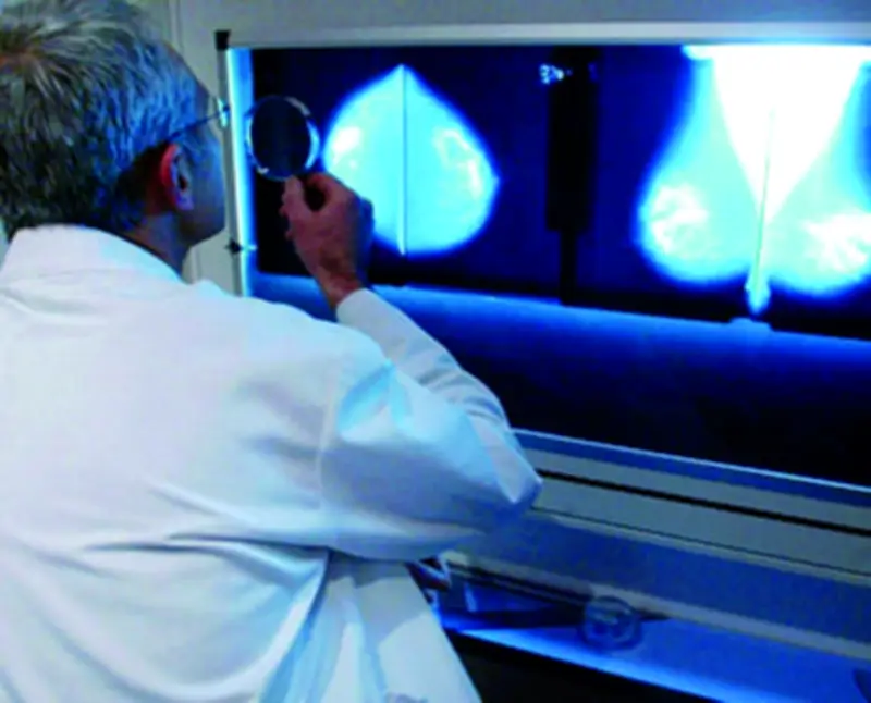 Dépistage du cancer du sein : des dizaines de milliers de vies sauvées selon l'Institut national du cancer