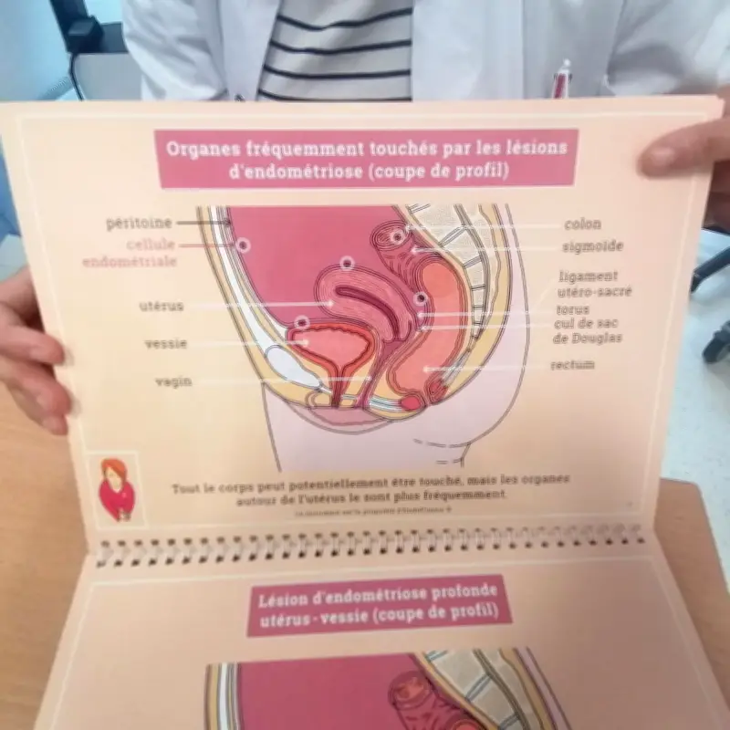 Endométriose : la Nouvelle-Aquitaine en pointe pour le diagnostic et la prise en charge
