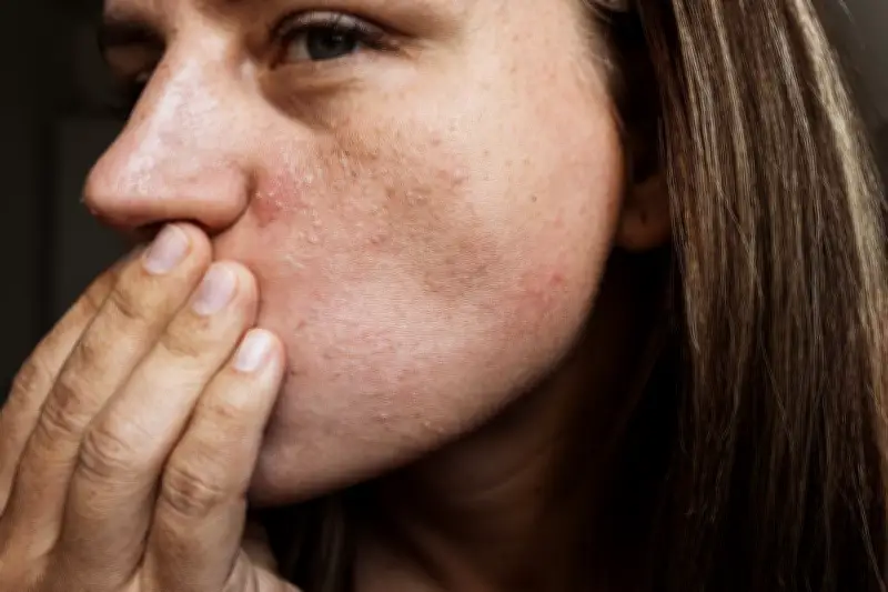 L'alerte de l'ANSM sur la tendance TikTok dangereuse autour des médicaments anti-acné