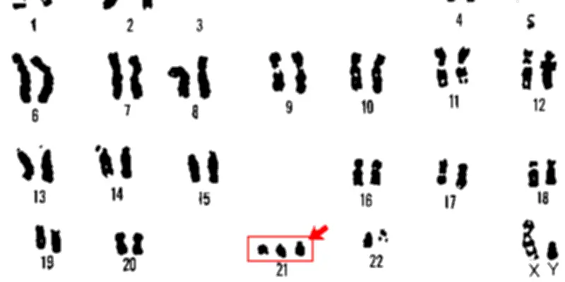 Marthe Gautier, la chercheuse oubliée derrière la découverte de la trisomie 21