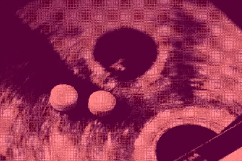 Mon IVG, mon choix : comment deux avortements m'ont sauvé la vie