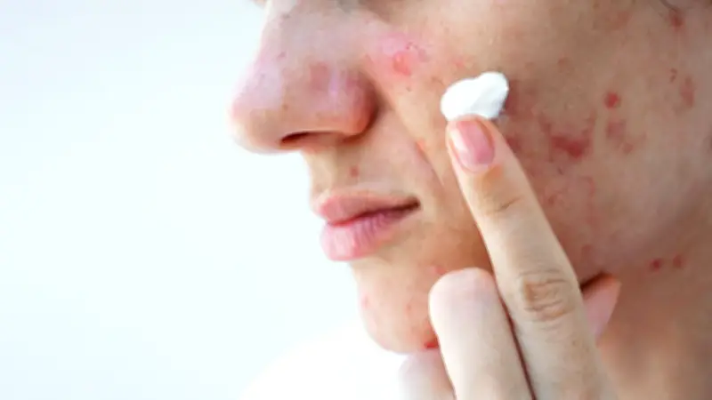 Rumeur TikTok sur l'isotrétinoïne : les médecins démêlent le vrai du faux