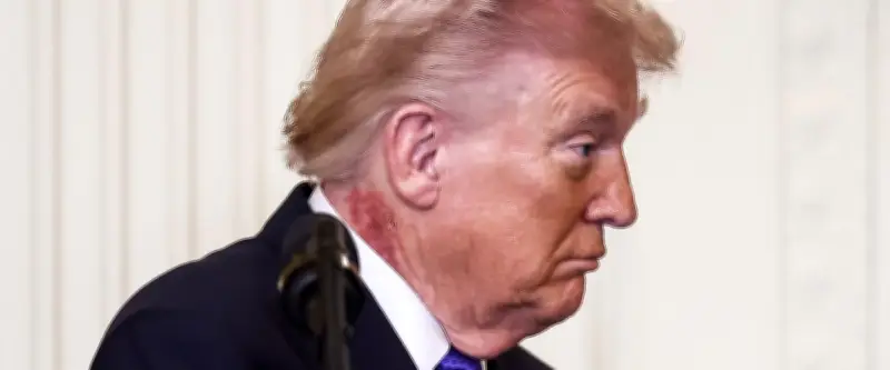 Une plaque rouge au cou de Trump relance les interrogations sur sa santé