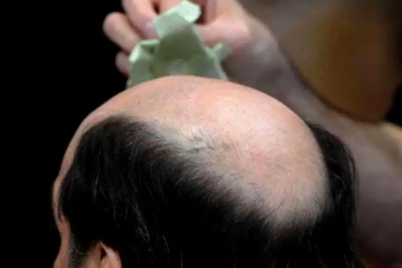 Calvitie : l'ANSM renforce l'encadrement du finastéride face aux risques psychiatriques graves