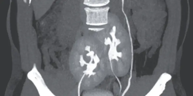 Certains patients possèdent trois ou quatre reins : une anomalie rare