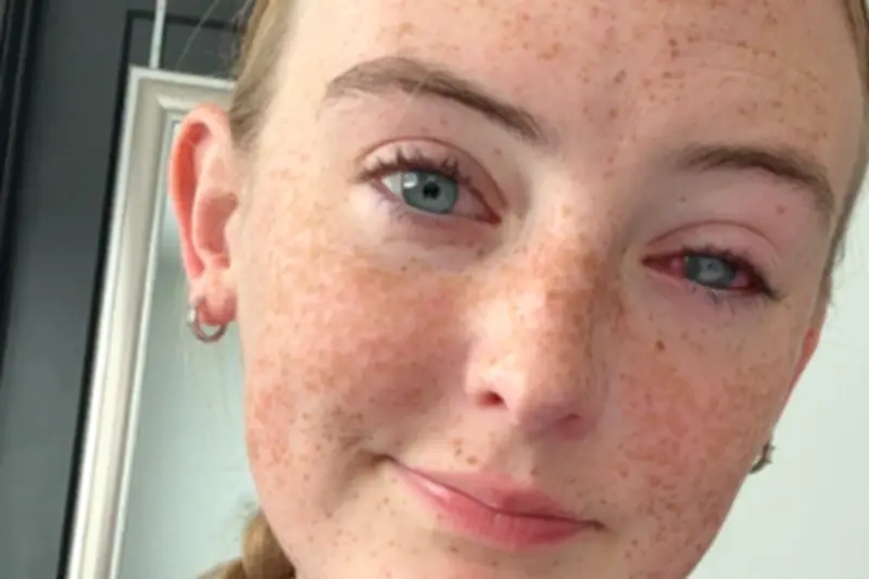 Elle perd la vue après une douche avec ses lentilles en République dominicaine