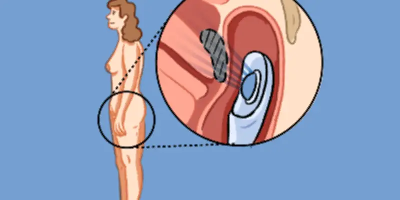 Endométriose digestive : les ultrasons évitent la chirurgie