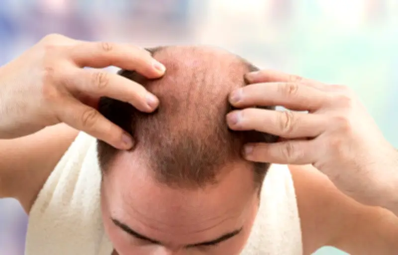 Finastéride : un encadrement renforcé pour le traitement de la calvitie dès avril