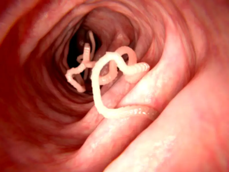 Le ver solitaire, un parasite intestinal qui peut vivre 40 ans dans le corps humain