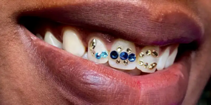 Les strass dentaires, une tendance clinquante qui séduit les amateurs de sourires éclatants