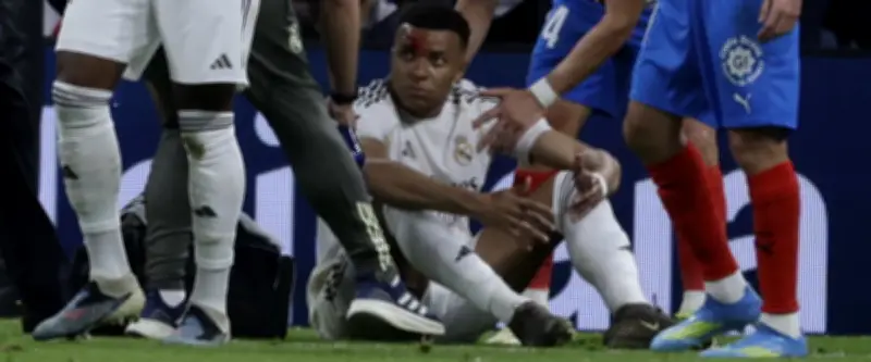 Mbappé absent de l'entraînement après une blessure au visage contre Gérone