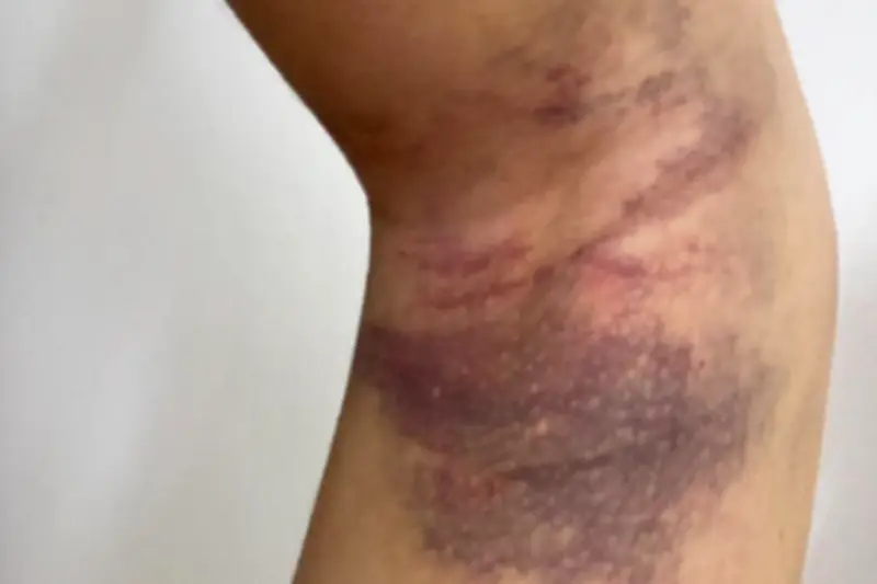 Morsure de vipère : une adolescente frôle la mort après une prise en charge inadaptée aux urgences