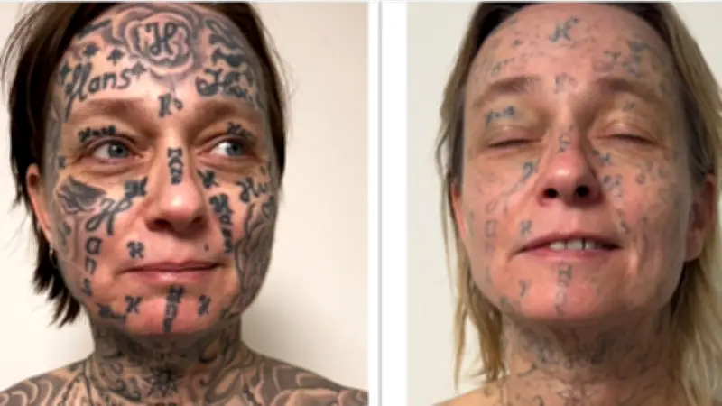 Pays-Bas : une femme forcée à 250 tatouages par son ex-compagnon lance une campagne de détatouage