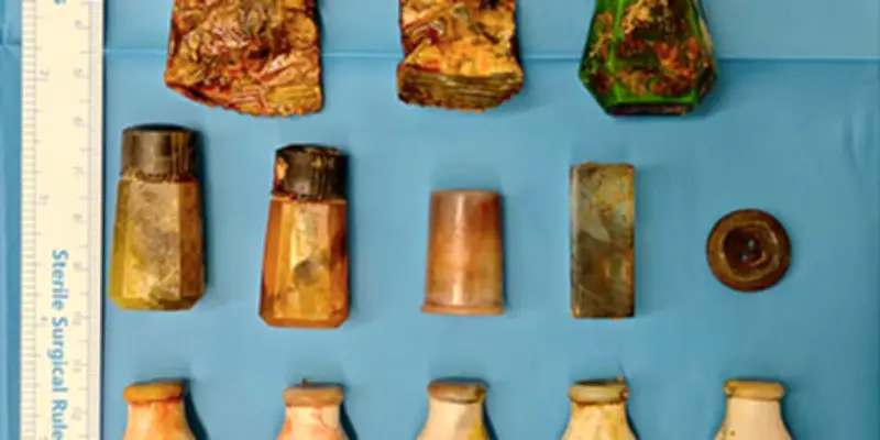 Treize corps étrangers retenus dans le vagin pendant 20 ans