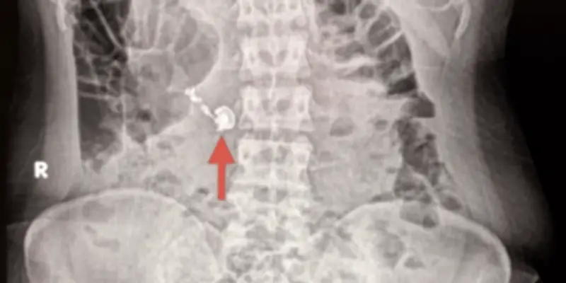 Une femme avale un écouteur sans fil, le confondant avec un comprimé