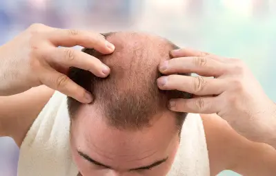 Finastéride : un encadrement renforcé pour le traitement de la calvitie dès avril