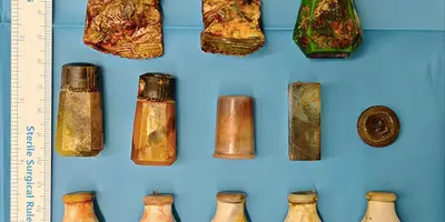 Treize corps étrangers retenus dans le vagin pendant 20 ans