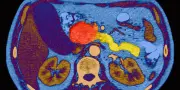 Cancer du pancréas : un nouveau traitement double l'espérance de vie des patients