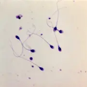 Congélation du sperme à domicile : le nouveau marché de la fertilité masculine