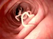 Le ver solitaire, un parasite intestinal qui peut vivre 40 ans dans le corps humain