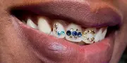 Les strass dentaires, une tendance clinquante qui séduit les amateurs de sourires éclatants