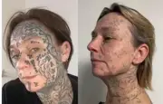 Pays-Bas : une campagne pour effacer les tatouages imposés aux femmes
