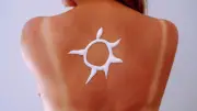 Sun-tattoo : une mode dangereuse qui inquiète les dermatologues