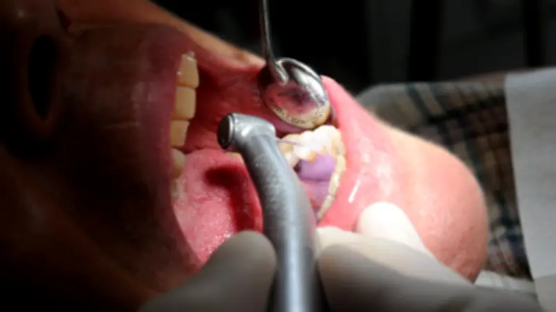 Ancien dentiste de Lozère jugé pour avoir arraché des dents saines
