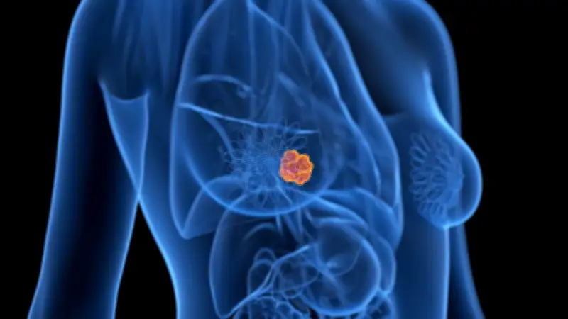 Cancer du sein : faute de décrets, des femmes renoncent aux soins