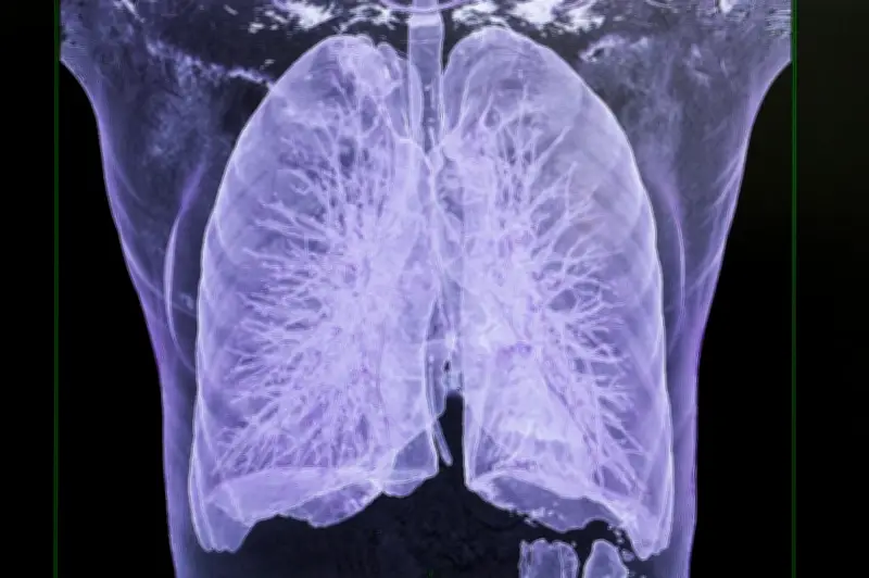 Dépistage du cancer du poumon : des vies sauvées grâce à un programme