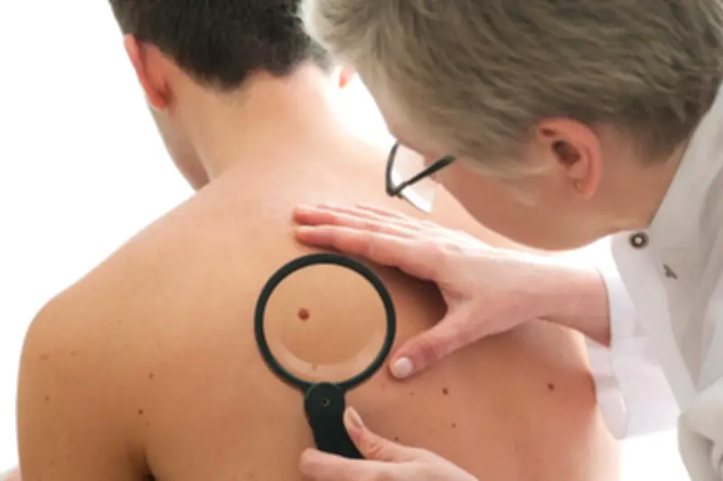 Mélanome : une enzyme clé identifiée à Nice pour bloquer les résistances