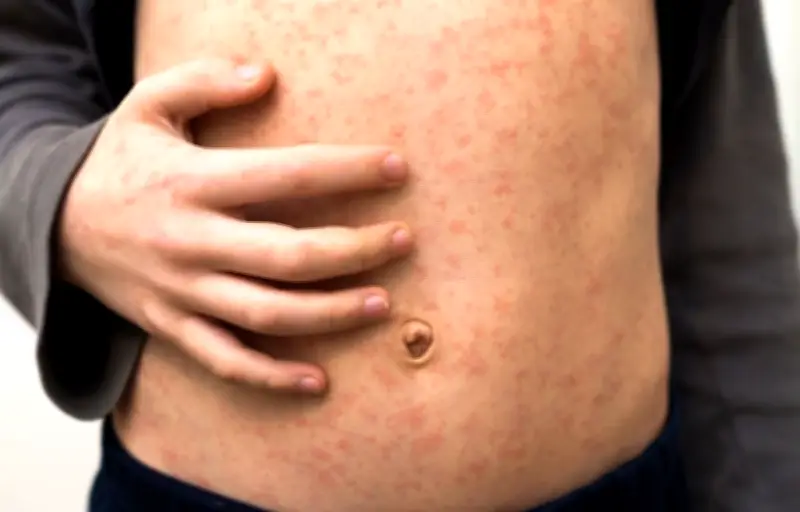 Rougeole : une résurgence inquiétante en France malgré la vaccination