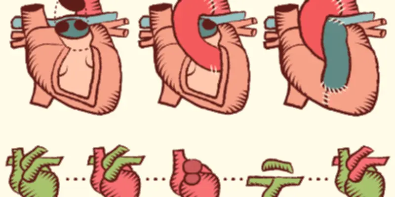 Transplantation cardiaque partielle : une révolution pour les très jeunes enfants