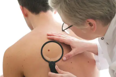 Mélanome : une enzyme clé identifiée à Nice pour bloquer les résistances