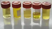 Cancer de la vessie : le sang dans les urines doit alerter, préviennent les urologues