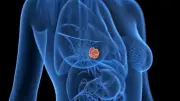 Cancer du sein : faute de décrets, des femmes renoncent aux soins