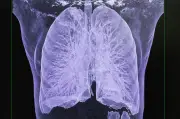 Dépistage du cancer du poumon : des vies sauvées grâce à un programme