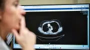 Dépistage gratuit du cancer du poumon : inscription ouverte dans 5 régions