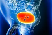 Mai Jaune : Dr Benziane alerte sur le cancer de la vessie
