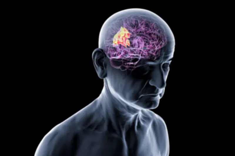 Disqualifier la vision romantique des maladies neurodégénératives