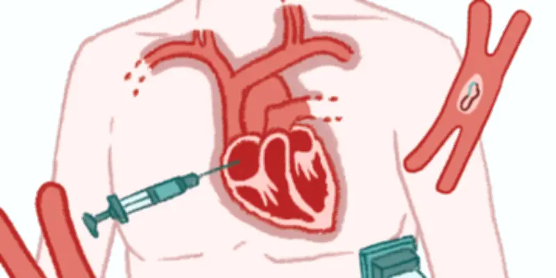Pacemaker externe par ultrasons pour réguler le rythme cardiaque