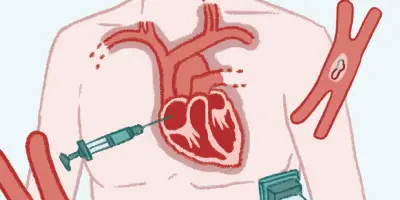 Pacemaker externe par ultrasons pour réguler le rythme cardiaque