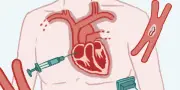 Pacemaker externe par ultrasons pour réguler le rythme cardiaque