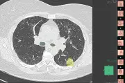 Au CHU de Nice, un logiciel 3D guide les biopsies pulmonaires